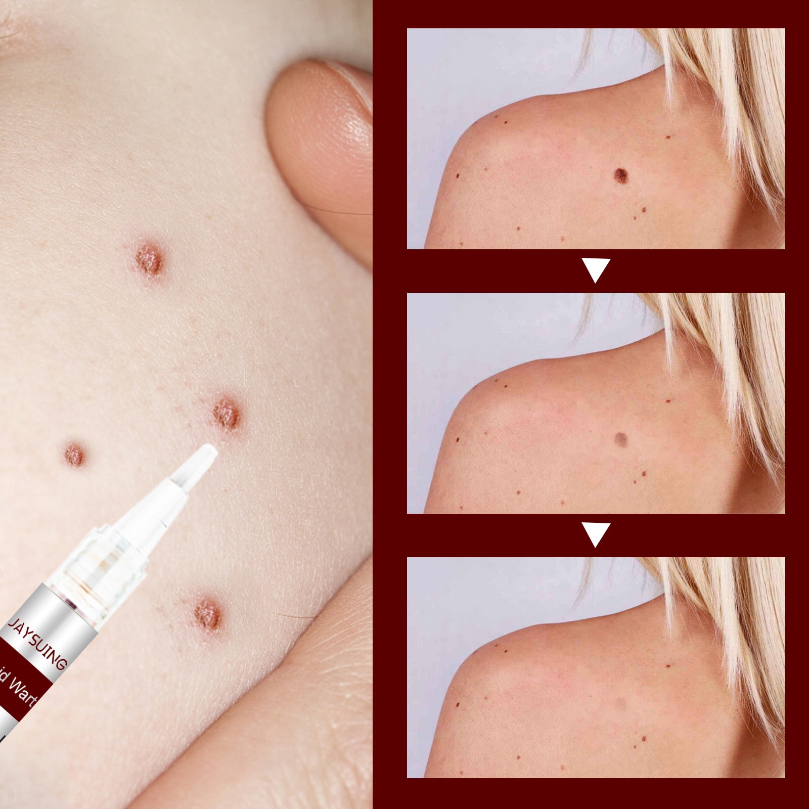 Gram Wart Liquid Pen Mole Removal Care