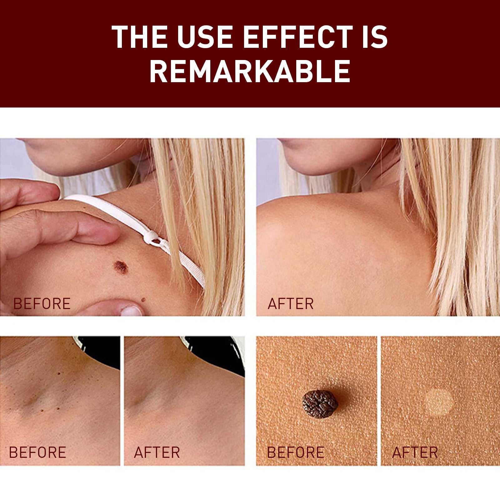 Gram Wart Liquid Pen Mole Removal Care