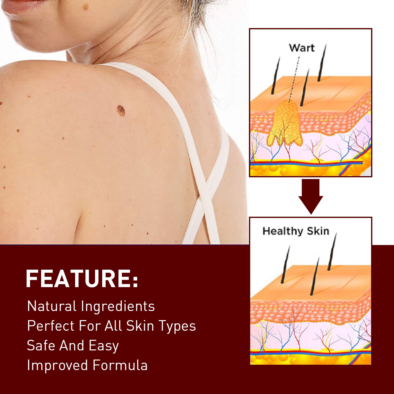 Gram Wart Liquid Pen Mole Removal Care